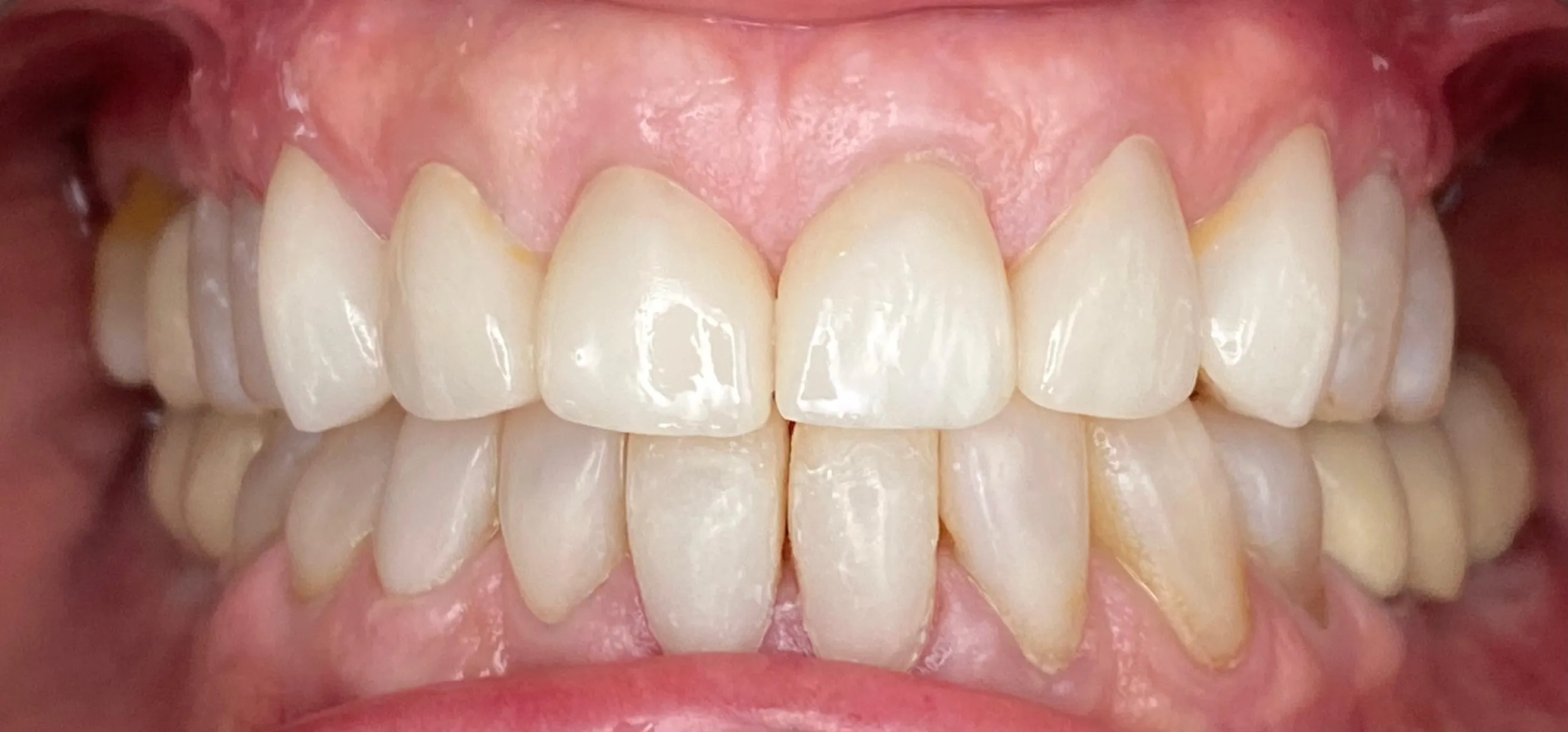 Sonrisa después del tratamiento con carillas First Fit: estética natural y armónica